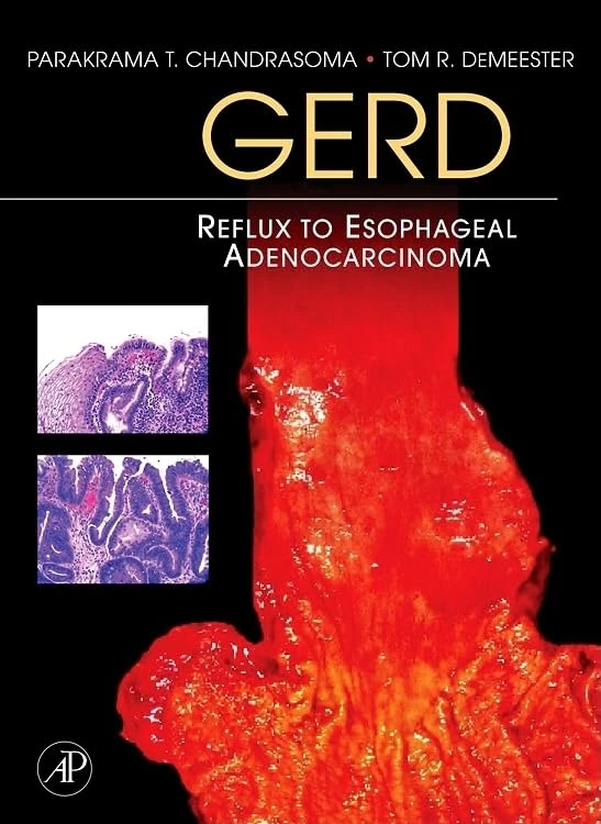 GERD: Reflux to Esophageal Adenocarcinoma