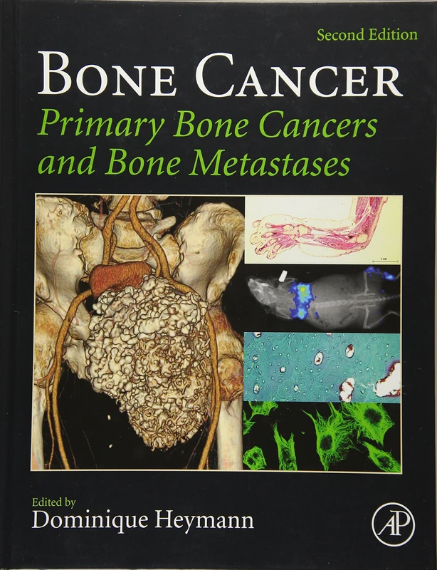 Bone Cancer: Primary Bone Cancers and Bone Metastases