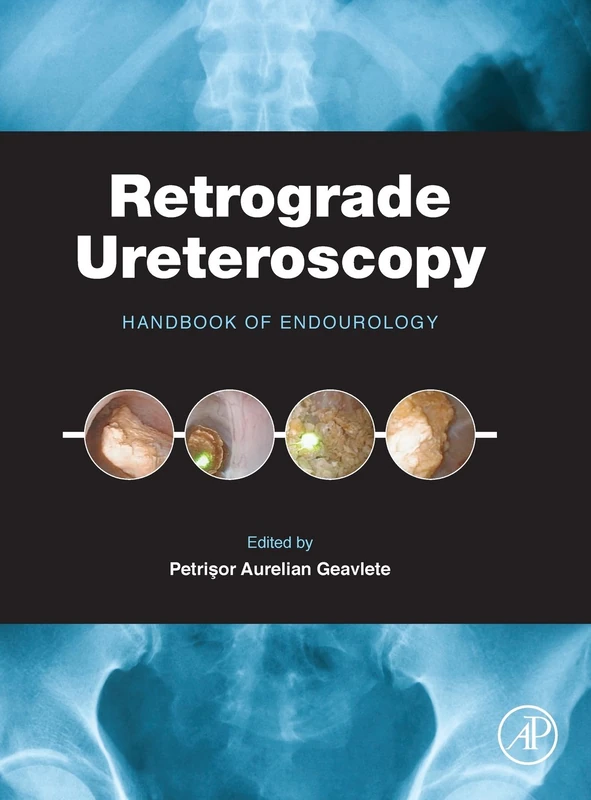 Retrograde Ureteroscopy: Handbook of Endourology
