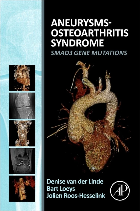 Aneurysms-Osteoarthritis Syndrome: SMAD3 Gene Mutations - Image 1