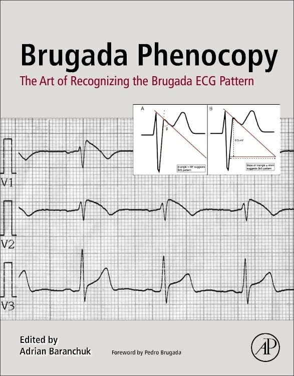 Academic Press - Brugada Phenocopy ECG Recognition Guide