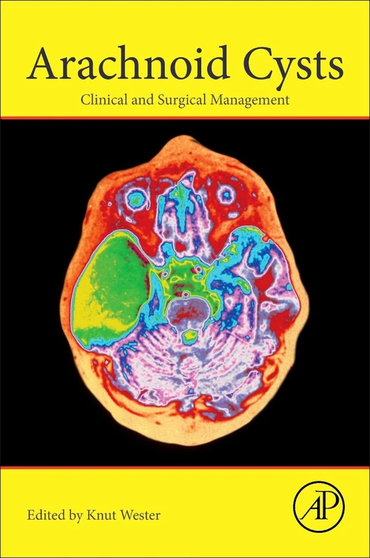 Arachnoid Cysts: Clinical and Surgical Management - Image 1