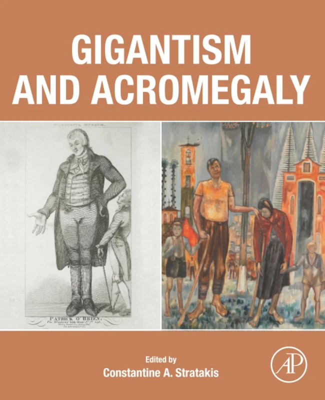 Gigantism and Acromegaly: Genetics, Diagnosis, and Treatment