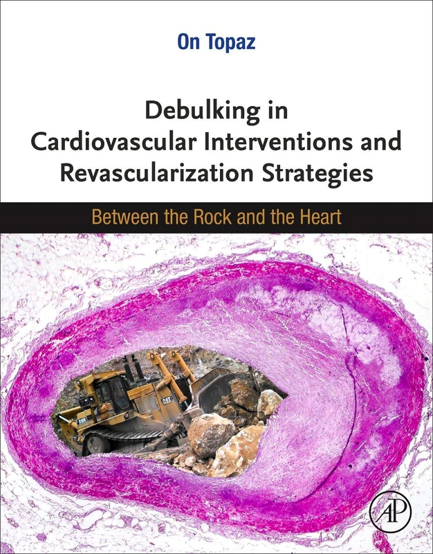 Academic Press - Debulking in Cardiovascular Interventions