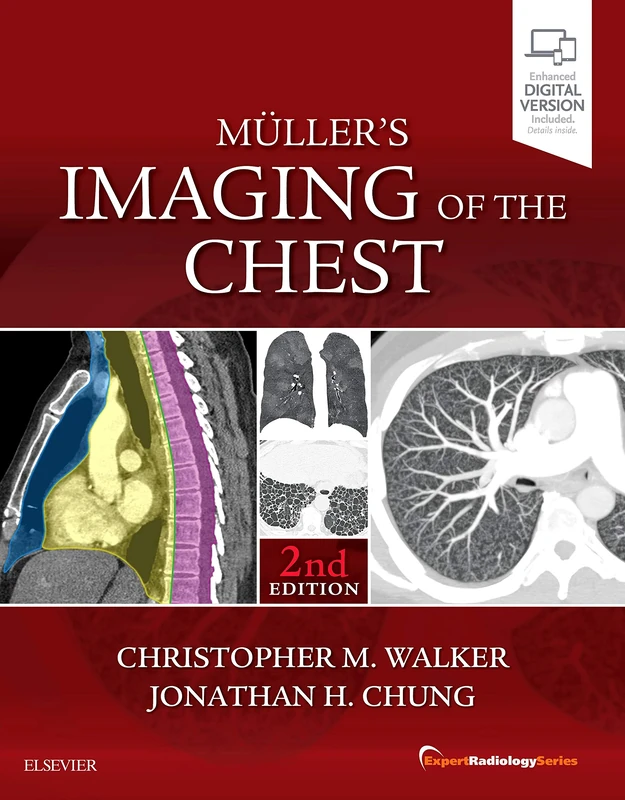 Muller's Imaging of the Chest: Expert Radiology Series