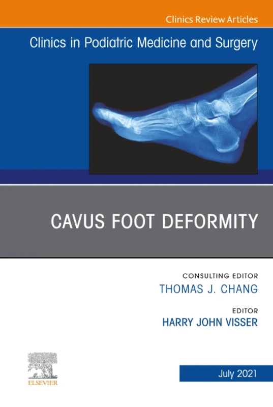 Cavus Foot Deformity, An Issue of Clinics in Podiatric Medicine and Surgery: Volume 38-3 (The Clinics: Orthopedics, Volume 38-3)