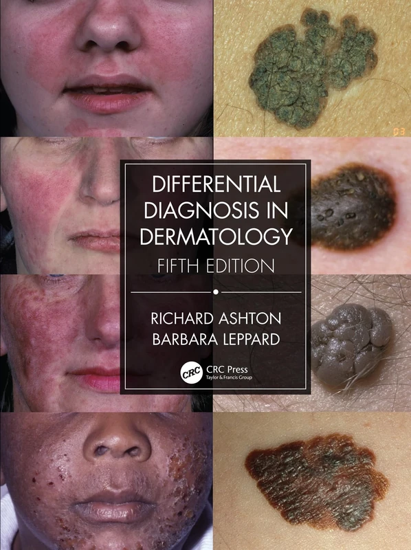 Differential Diagnosis in Dermatology