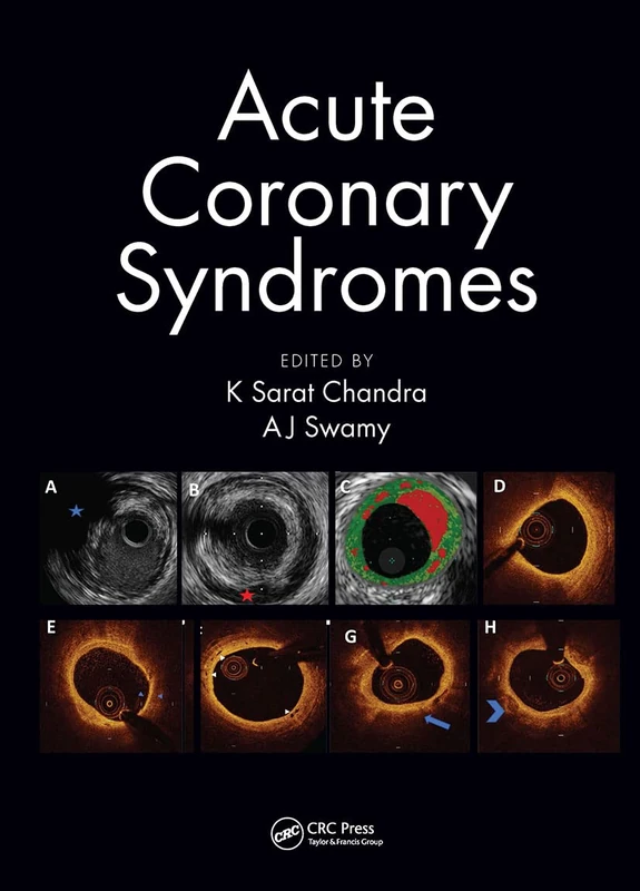 Acute Coronary Syndromes