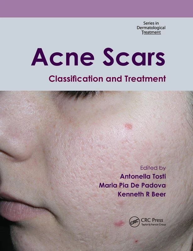 Acne Scars: Classification and Treatment (Series in Dermatological Treatment)