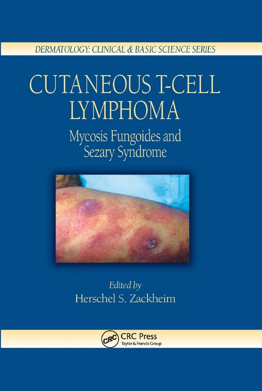 Cutaneous T-Cell Lymphoma: Mycosis Fungoides and Sezary Syndrome: 26 (Dermatology: Clinical & Basic Science)