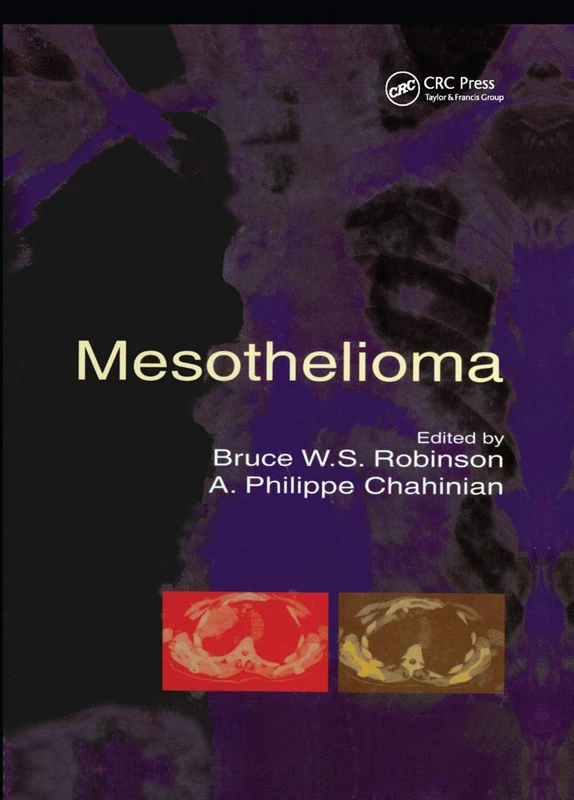 Mesothelioma - Image 1