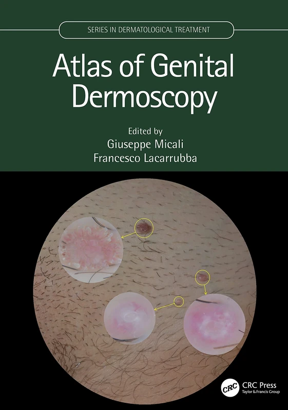 Atlas of Genital Dermoscopy (Series in Dermatological Treatment)