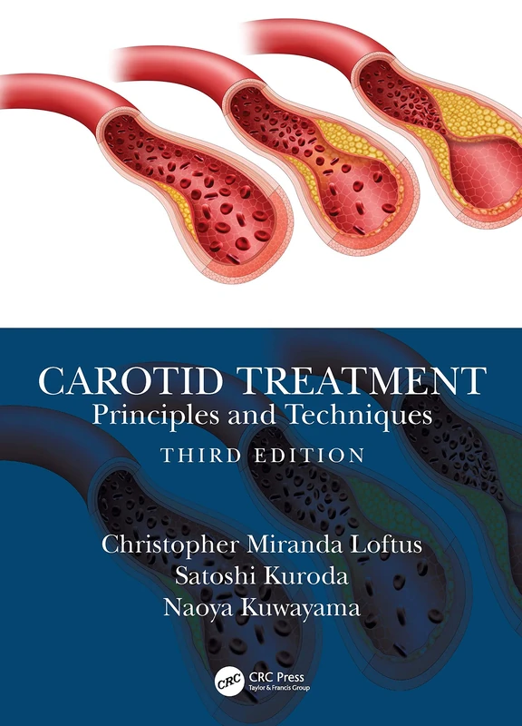 CRC Press - Carotid Treatment: Principles and Techniques