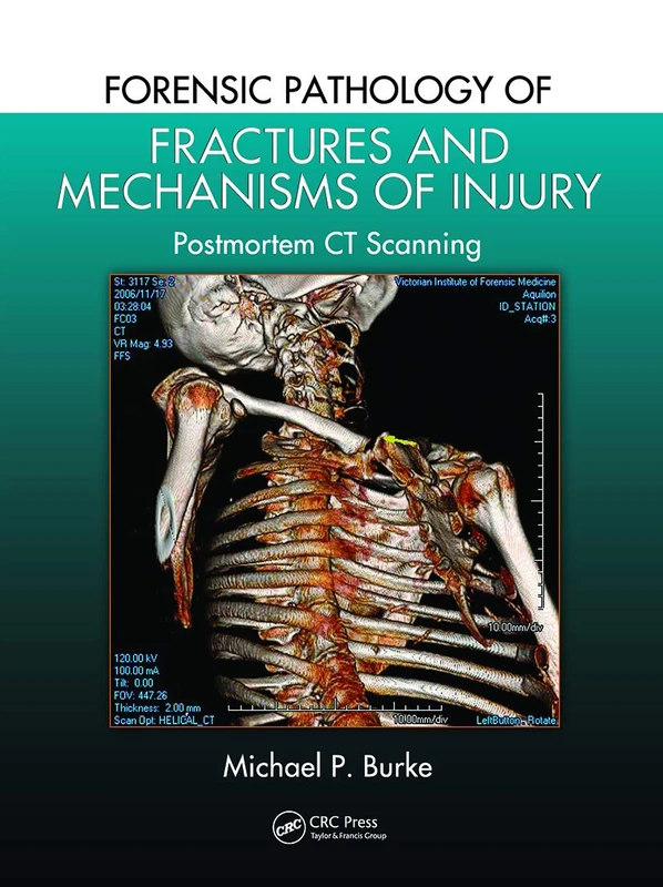 Forensic Pathology of Fractures and Mechanisms of Injury: Postmortem CT Scanning