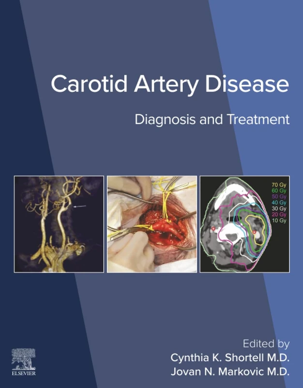 Carotid Artery Disease: Diagnosis and Treatment