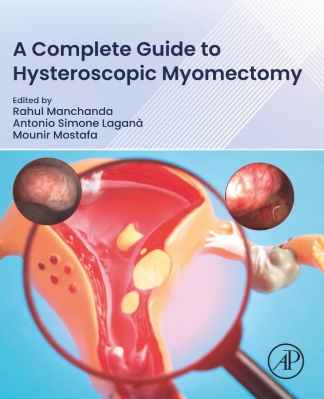 A Complete Guide to Hysteroscopic Myomectomy