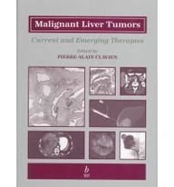 Malignant Liver Tumors: Current and Emerging Therapies