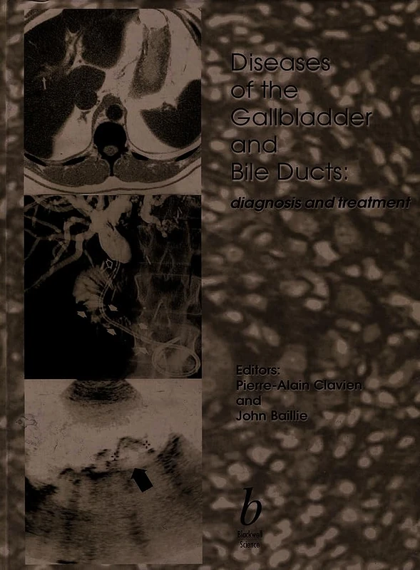 Diseases of the Gallbladder and Bile Ducts: Diagnosis and Treatment