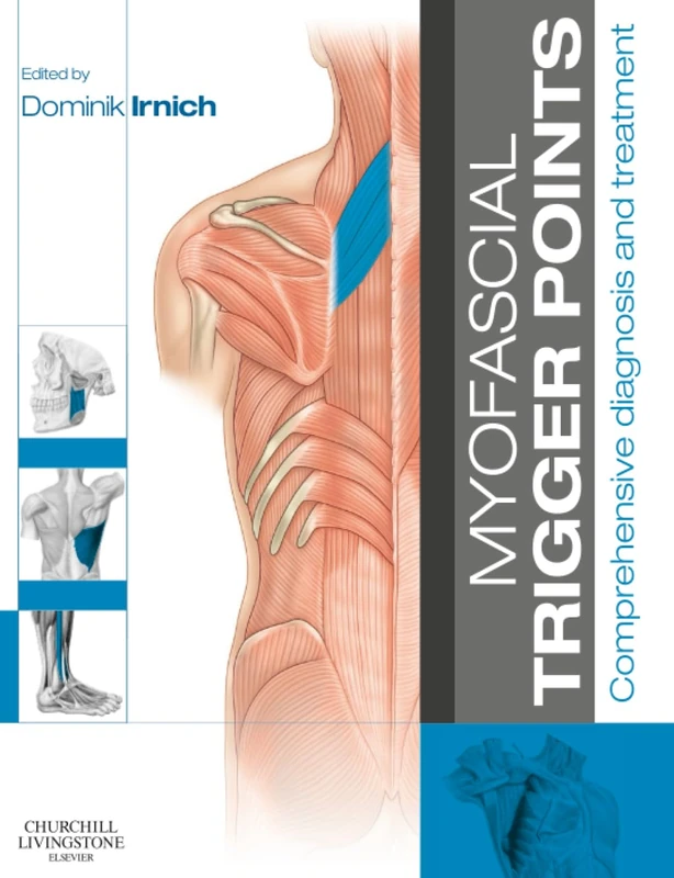 Myofascial Trigger Points: Comprehensive diagnosis and treatment
