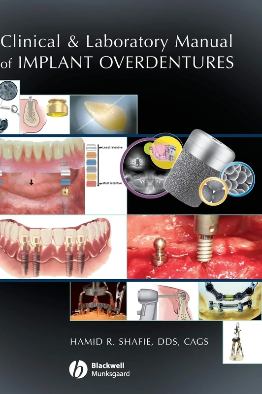 Wiley Clinical and Laboratory Manual of Implant Overdentures - Image 1