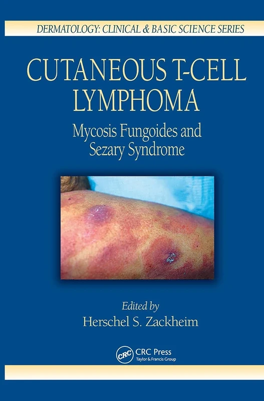 Cutaneous T-Cell Lymphoma: Mycosis Fungoides and Sezary Syndrome: 26 (Dermatology: Clinical & Basic Science)