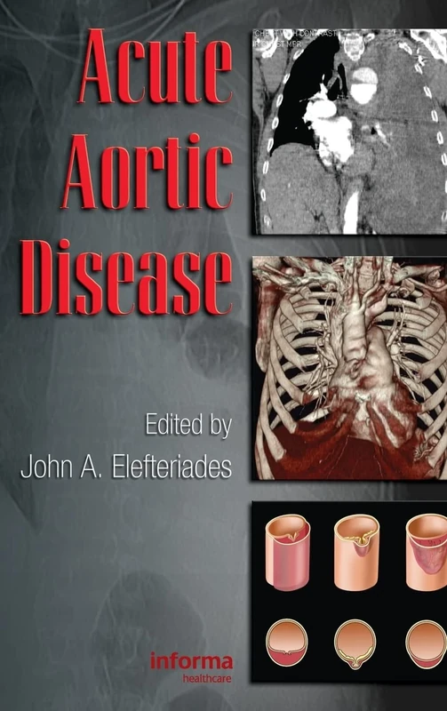 Acute Aortic Disease: 61 (Fundamental and Clinical Cardiology)
