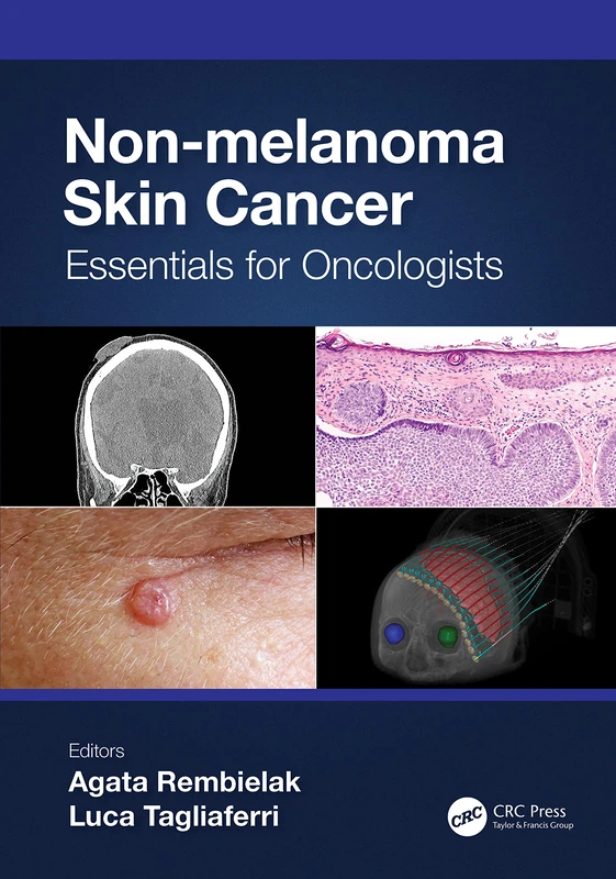 Non-melanoma Skin Cancer: Essentials for Oncologists (Series in Medical Physics and Biomedical Engineering)