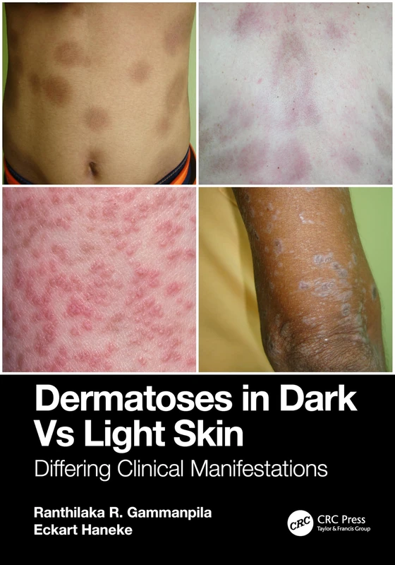 CRC Press - Dermatoses in Dark Vs Light Skin Book