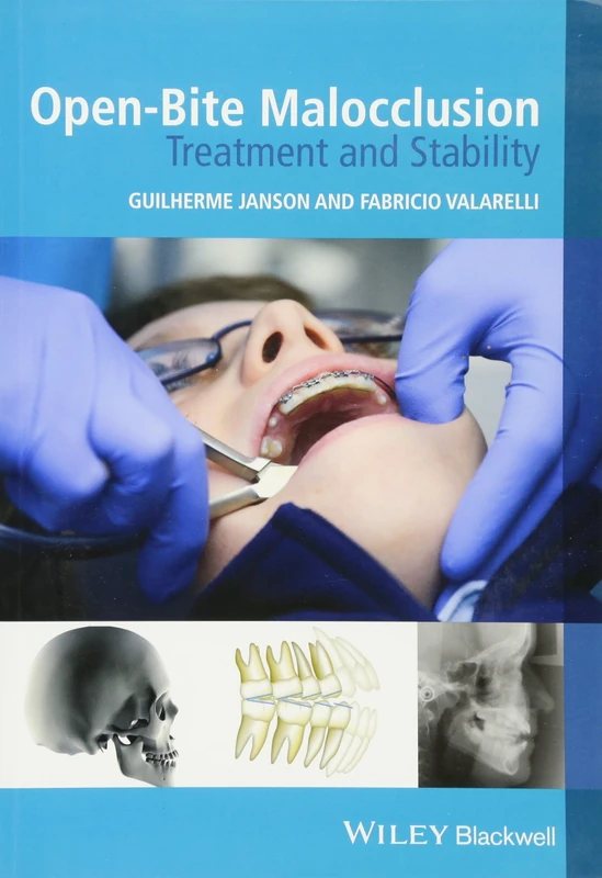 Open-Bite Malocclusion: Treatment and Stability