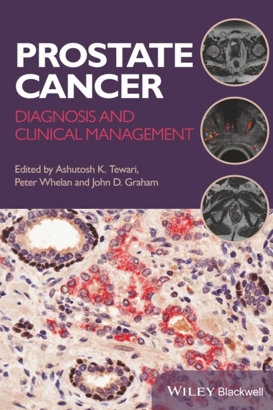 Prostate Cancer: Diagnosis and Clinical Management