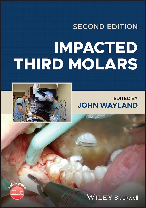 Impacted Third Molars