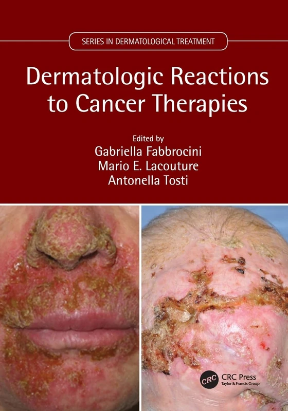 Dermatologic Reactions to Cancer Therapies (Series in Dermatological Treatment)