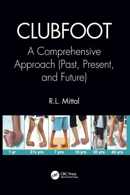 Clubfoot: A Comprehensive Approach (Past, Present, and Future)
