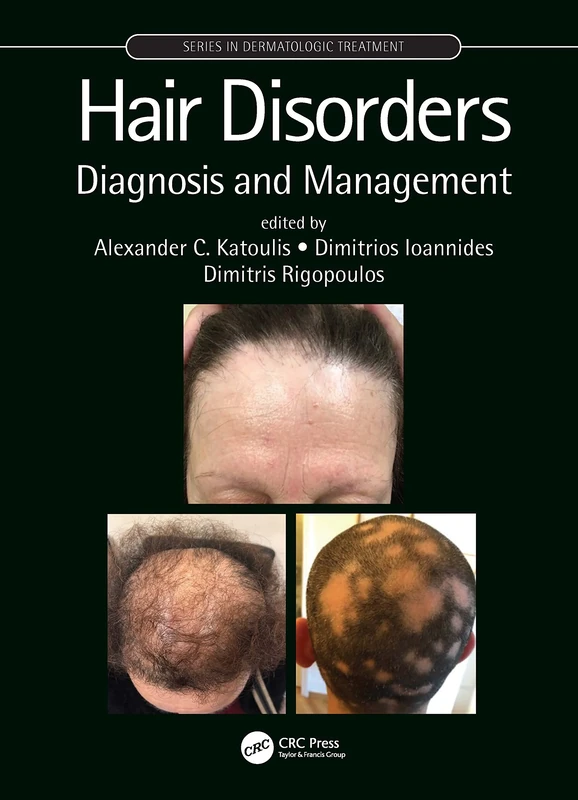 Hair Disorders: Diagnosis and Management (Series in Dermatological Treatment)