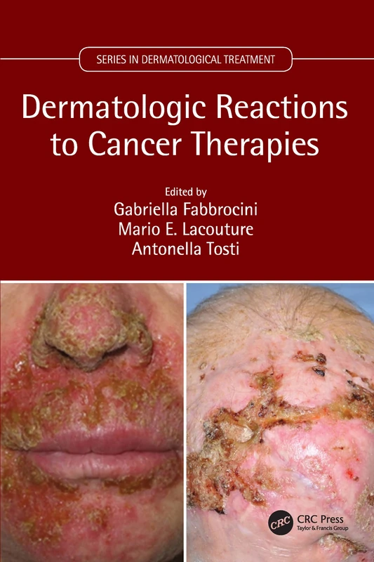 Dermatologic Reactions to Cancer Therapies (Series in Dermatological Treatment)