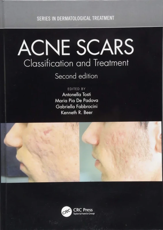Acne Scars: Classification and Treatment, Second Edition (Series in Dermatological Treatment)