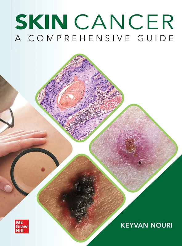 Skin Cancer: A Comprehensive Guide (DERMATOLOGY)