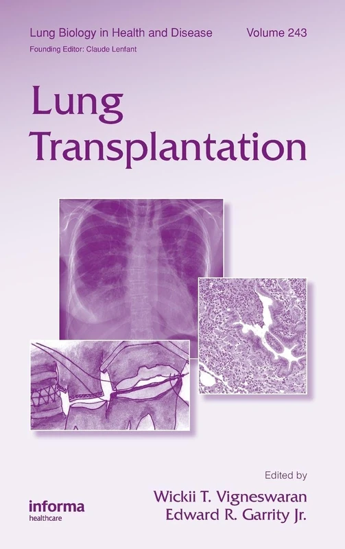 Lung Transplantation: 243 (Lung Biology in Health and Disease)