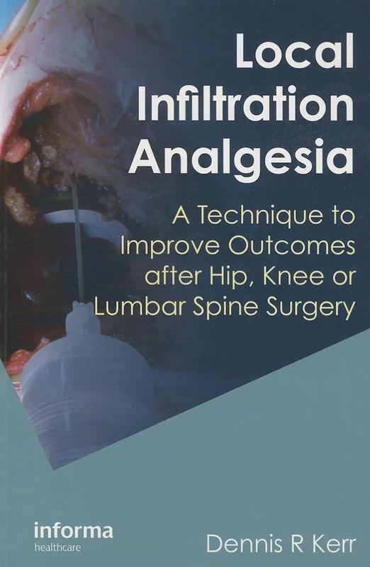 Local Infiltration Analgesia: A Technique to Improve Outcomes after Hip, Knee or Lumbar Spine Surgery - Image 1