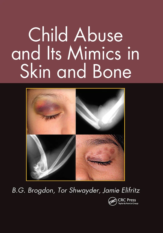 Child Abuse and its Mimics in Skin and Bone - Image 1