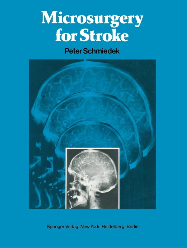 Microsurgery for Stroke - Image 1