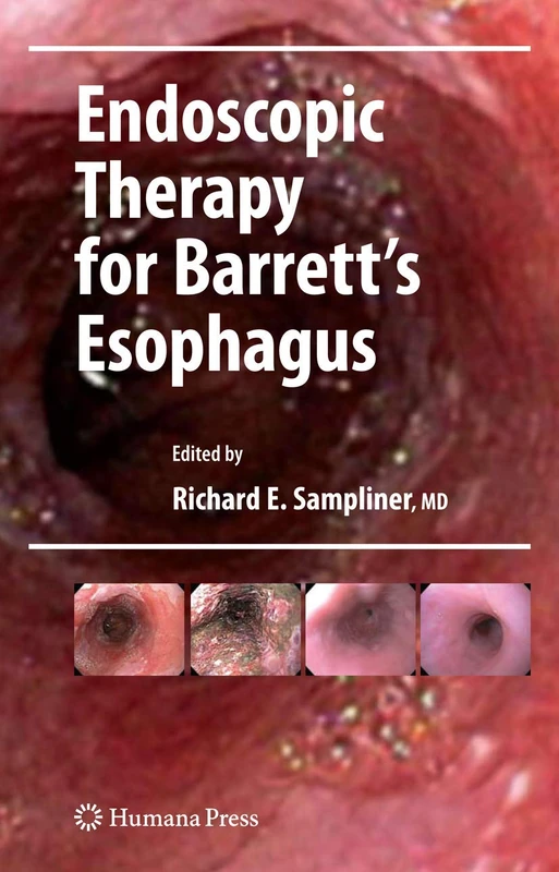 Endoscopic Therapy for Barrett's Esophagus (Clinical Gastroenterology)