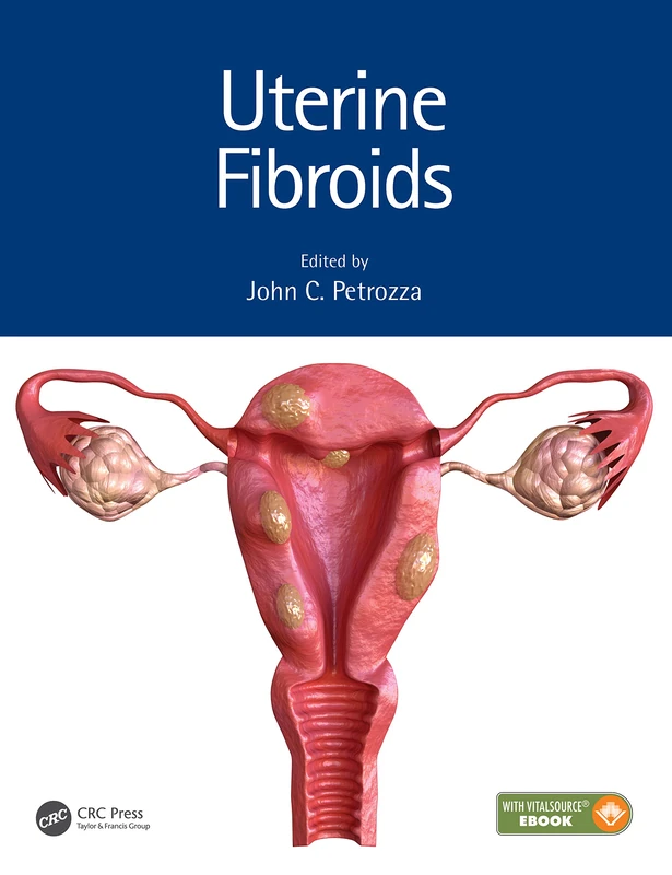 CRC Press Uterine Fibroids - Reproductive Medicine Textbook - Image 1