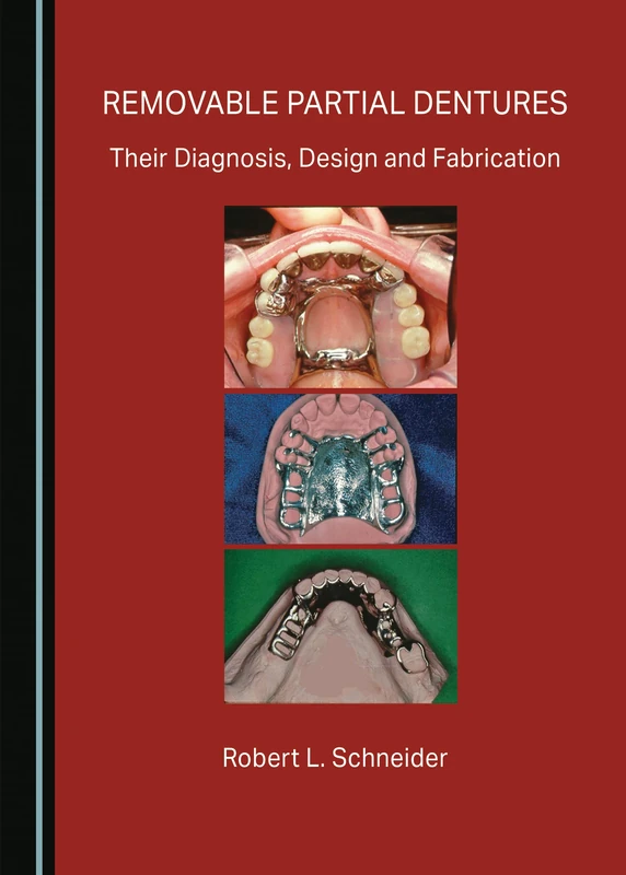 Removable Partial Dentures: Their Diagnosis, Design and Fabrication
