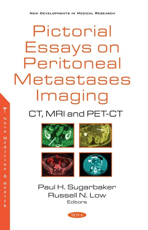 Pictorial Essays on Peritoneal Metastases Imaging: CT, MRI and PET-CT (New Developments in Medical Research) - Image 1