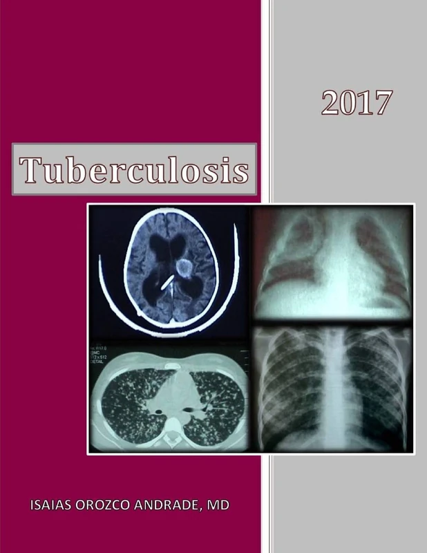 Tuberculosis 2017: English Edition