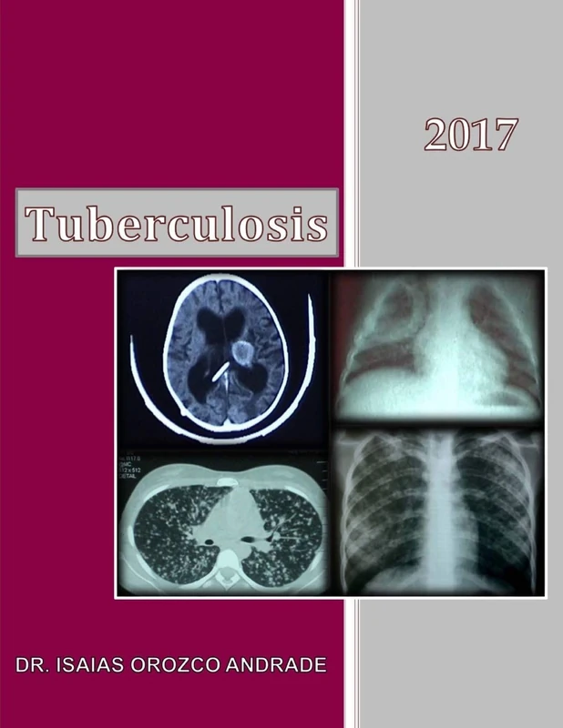 Tuberculosis 2017: Spanish Edition