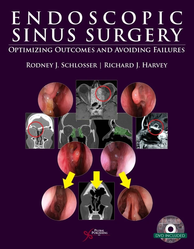 Endoscopic Sinus Surgery: Optimizing Outcomes and Avoiding Failures