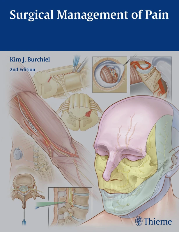 Thieme Surgical Management of Pain - Neurosurgical Review