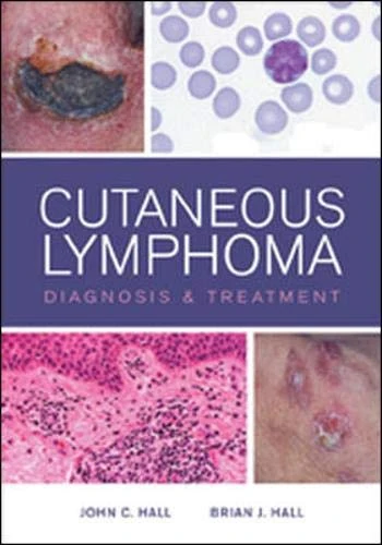 Cutaneous Lymphoma Diagnosis and Treatment
